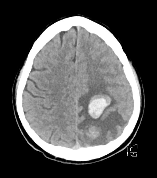 Cerebral metastases - testicular choriocarcinoma (Radiopaedia 84486-99855 Axial non-contrast 18).jpg