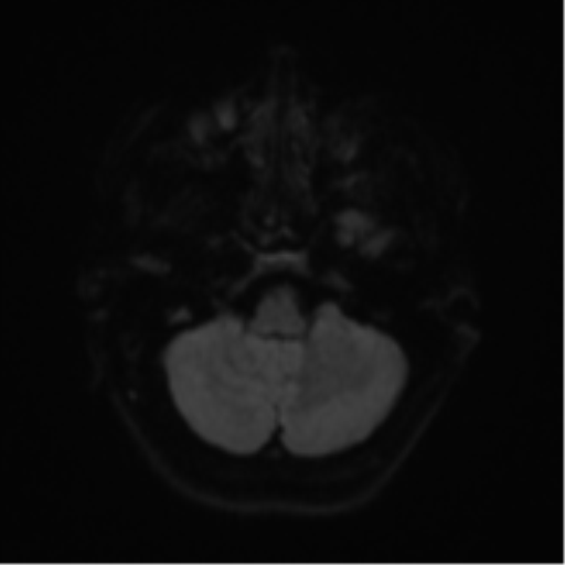 Cerebral metastases mimicking abscesses (Radiopaedia 45841-50131 Axial DWI 35).png