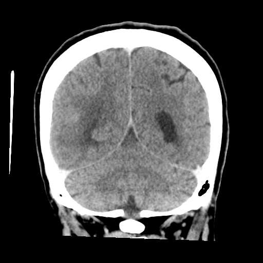 Cerebral metastasis to basal ganglia (Radiopaedia 81568-95412 Coronal C+ delayed 46).png