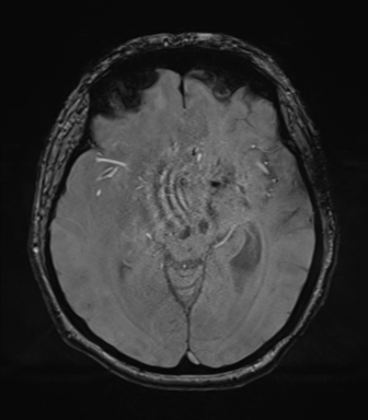 File:Cerebral metastasis to basal ganglia (Radiopaedia 81568-95413 Axial SWI magnitude 36).png