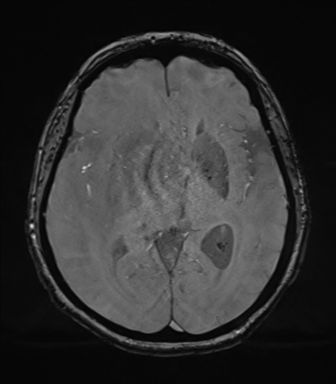 Cerebral metastasis to basal ganglia (Radiopaedia 81568-95413 Axial SWI magnitude 41).png
