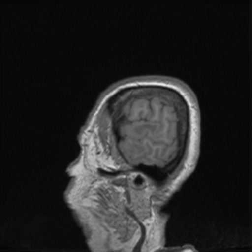 Cerebral metastasis to basal ganglia (Radiopaedia 81568-95413 Sagittal T1 72).png