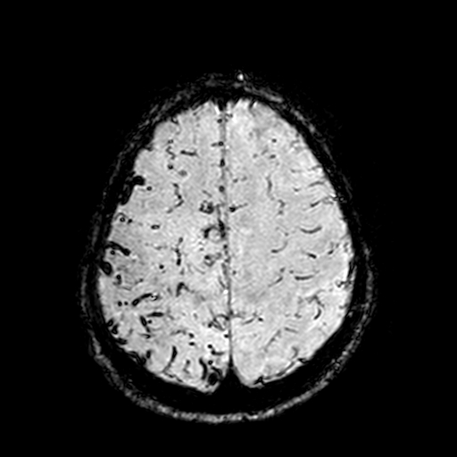 Cerebral parenchymal arteriovenous malformation (Radiopaedia 27280-27456 Axial SWI 98).jpg