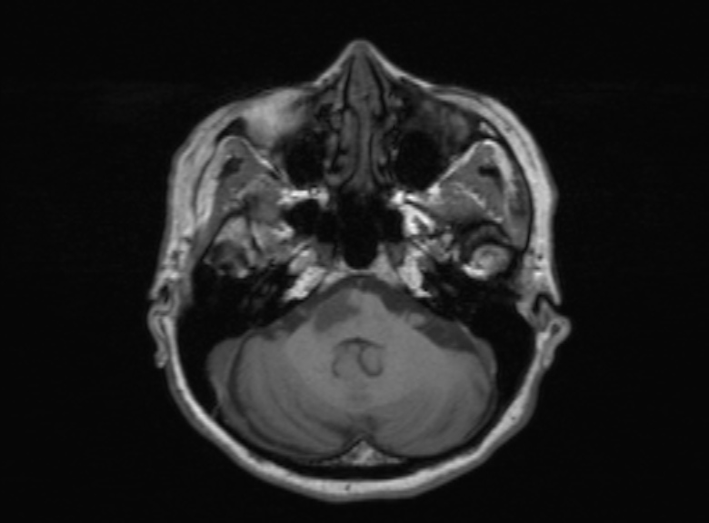 Cerebral ring enhancing lesions - cerebral metastases (Radiopaedia 44922-48817 Axial T1 305).jpg