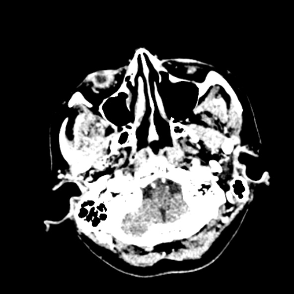 Cerebral ring enhancing lesions - cerebral metastases (Radiopaedia 44922-48818 B 37).jpg