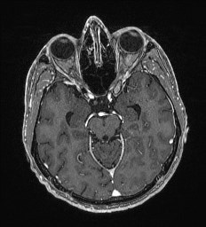 Cerebral toxoplasmosis (Radiopaedia 43956-47461 Axial T1 C+ 26).jpg
