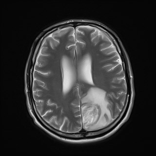 File:Cerebral toxoplasmosis (Radiopaedia 43956-47461 Axial T2 15).jpg