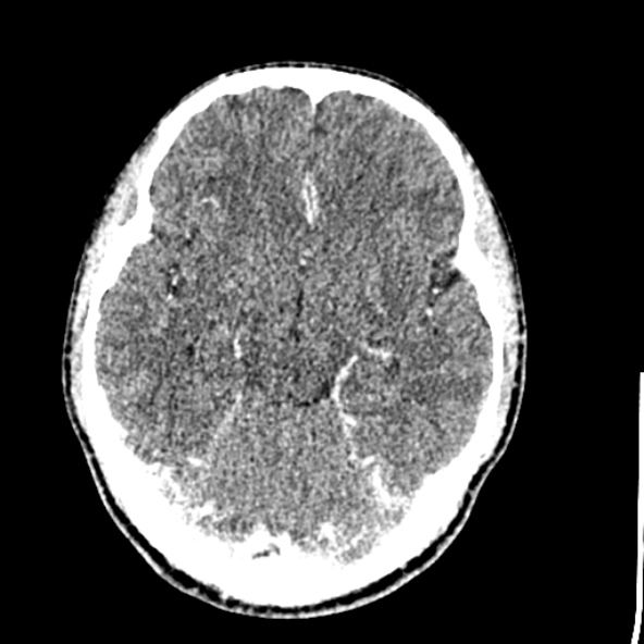 Cerebral toxoplasmosis (Radiopaedia 53993-60131 Axial C+ delayed 30).jpg