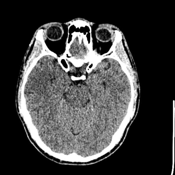 Cerebral toxoplasmosis (Radiopaedia 53993-60131 Axial non-contrast 30).jpg