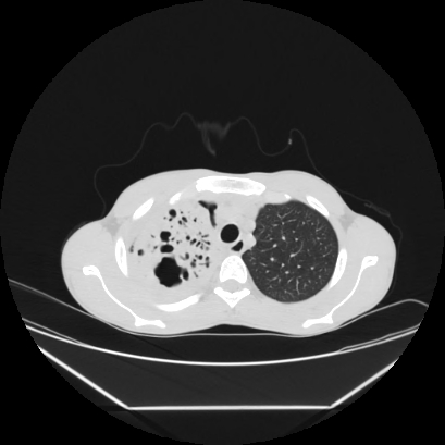 Cerebral tuberculoma (Radiopaedia 80829-94318 Axial lung window 32).jpg