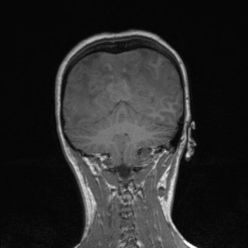 Cerebral tuberculosis with dural sinus invasion (Radiopaedia 60353-68090 Coronal T1 138).jpg