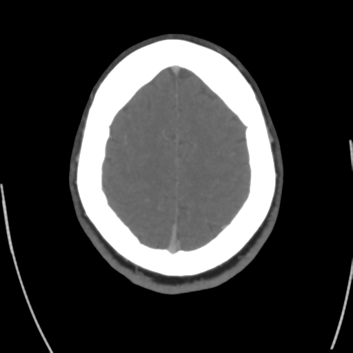 Cerebral venous infarct related to dural venous sinus thromboses (Radiopaedia 35292-36804 Axial C+ delayed 40).png