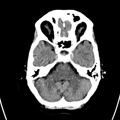 File:Cerebral venous infarction with hemorrhage (Radiopaedia 65343-74381 Axial non-contrast 5).jpg