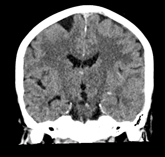 Cerebral venous infarction with hemorrhage (Radiopaedia 65343-74381 Coronal non-contrast 27).jpg