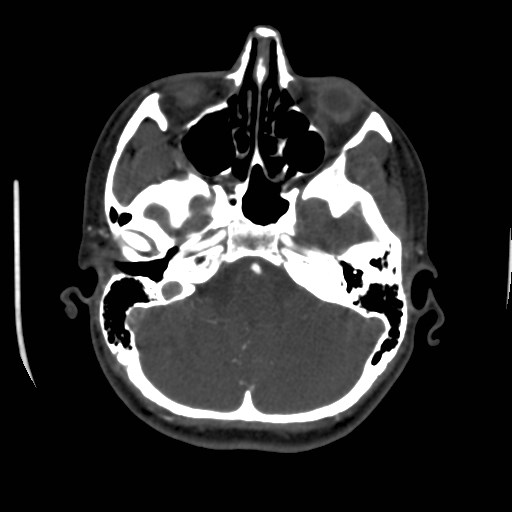 Cerebral venous sinus thrombosis (Radiopaedia 40619-43227 A 49).jpg