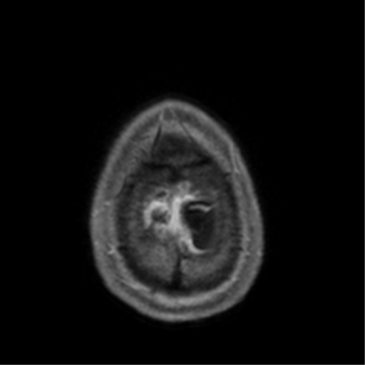 Cerebral venous thrombosis (Radiopaedia 38392-40469 Axial T1 C+ 74).png