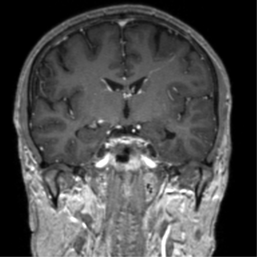 Cerebral venous thrombosis (Radiopaedia 38392-40469 Coronal T1 C+ 47).png