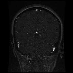 Cerebral venous thrombosis - ulcerative colitis (Radiopaedia 66049-75219 Coronal MRV 40).jpg