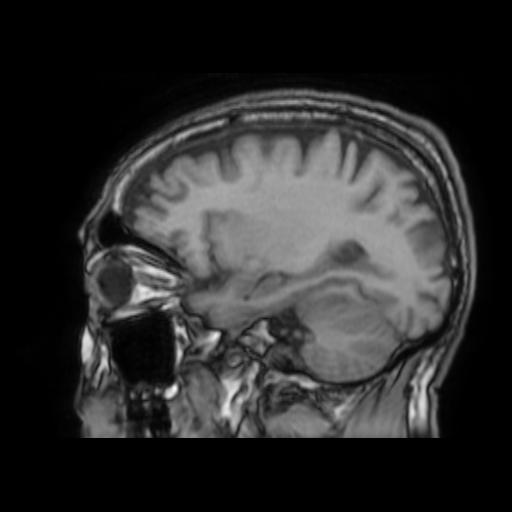 File:Cerebral venous thrombosis with secondary intracranial hypertension (Radiopaedia 89842-106957 Sagittal T1 21).jpg