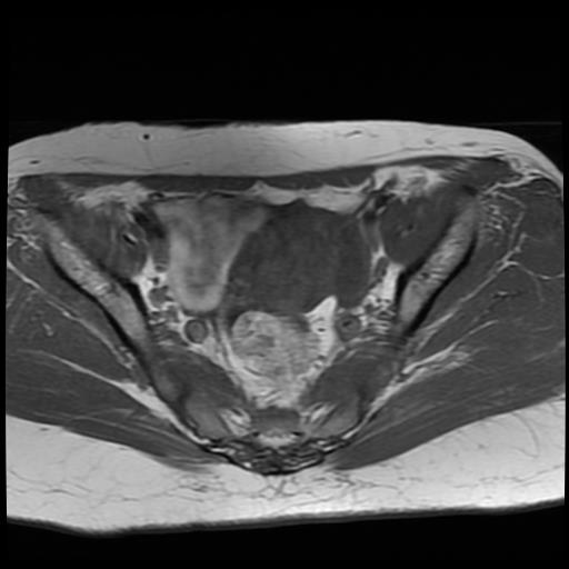 File:Cervical cancer (Radiopaedia 62991-71413 Axial T1 7).jpg