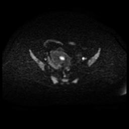 Cervical carcinoma (Radiopaedia 88010-104555 Axial DWI 54).jpg