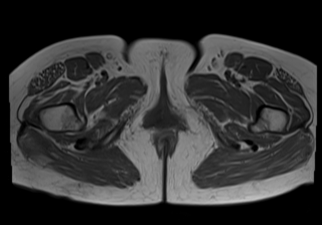 File:Cervical carcinoma (Radiopaedia 88312-104943 Axial T1 22).jpg