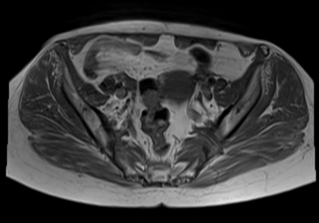 File:Cervical carcinoma (Radiopaedia 88312-104943 Axial T1 9).jpg