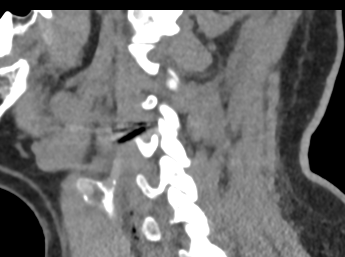 File:Cervical disc replacement (Radiopaedia 44025-47541 B 34).png