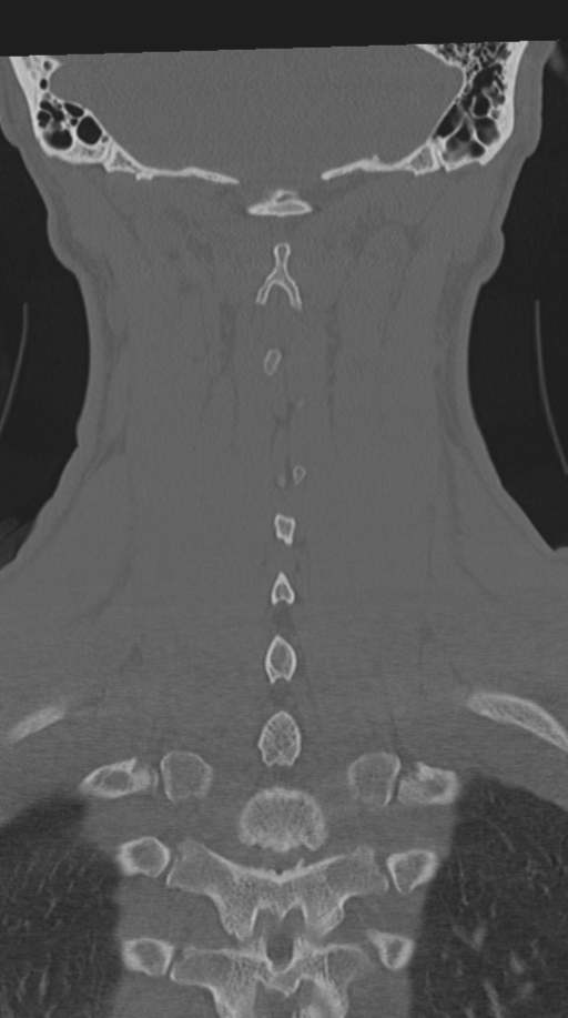 Cervical intercalary bone (Radiopaedia 35211-36748 Coronal bone window 60).png