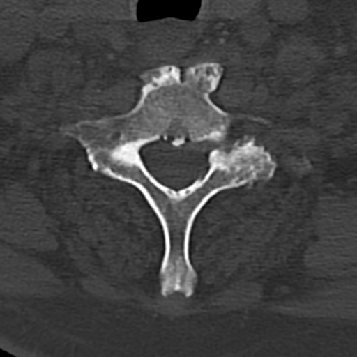 Cervical spine fracture - chalk stick (Radiopaedia 39116-41323 Axial bone window 73).png