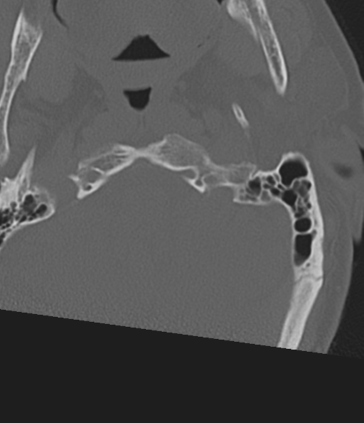 Cervical spine fracture in the setting of ankylosis (Radiopaedia 37038-38715 Axial bone window 7).png