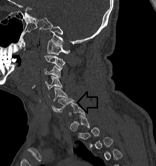 File:Cervical spine trauma with tear drop fracture and perched facet joint (Radiopaedia 53989-60765 Sagittal 1).jpg