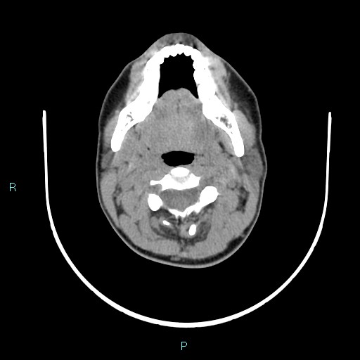 File:Cervical thymic cyst (Radiopaedia 88632-105335 Axial non-contrast 81).jpg