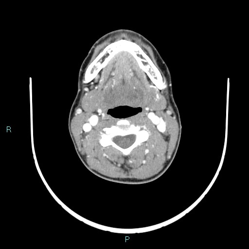 Cervical thymic cyst (Radiopaedia 88632-105335 B 72).jpg