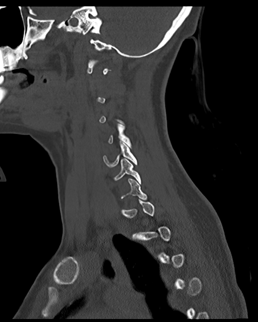 Cervical tuberculous spondylitis (Radiopaedia 39149-41365 Sagittal bone window 21).png