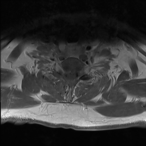 File:Cervical tumor-like myelopathy due to Type V dAVF (Radiopaedia 82461-96604 Axial T1 C+ fat sat 30).jpg