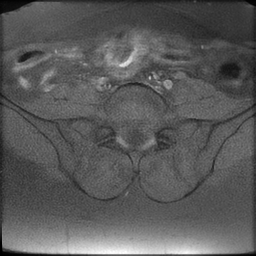 File:Cesarean scar ectopic pregnancy (Radiopaedia 77286-89362 Axial T1 fat sat 1).jpg