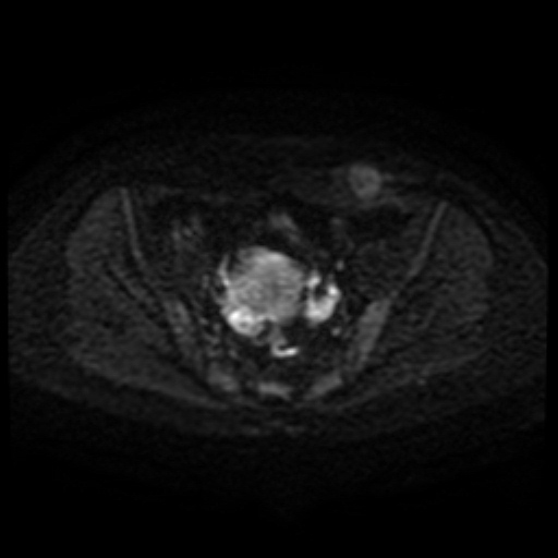 Cesarian section scar endometriosis (Radiopaedia 66520-75799 Axial DWI 59).jpg