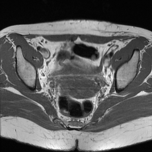 File:Cesarian section scar endometriosis (Radiopaedia 66520-75799 Axial T1 12).jpg