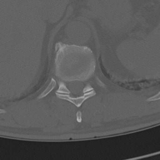 Chance fracture (Radiopaedia 33854-35020 Axial bone window 74).png