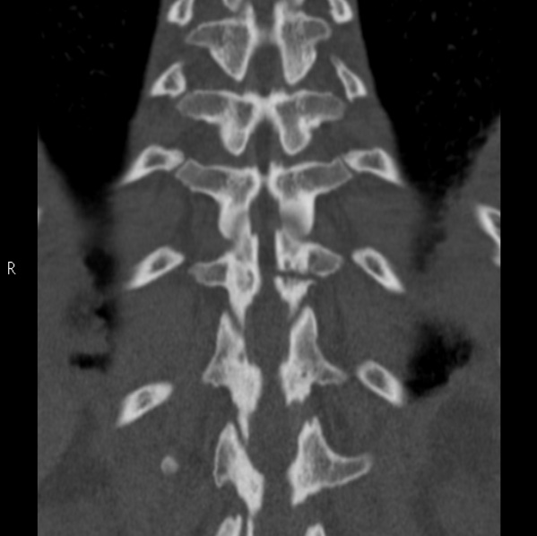 Chance fracture (Radiopaedia 36521-38081 Coronal bone window 47).jpg