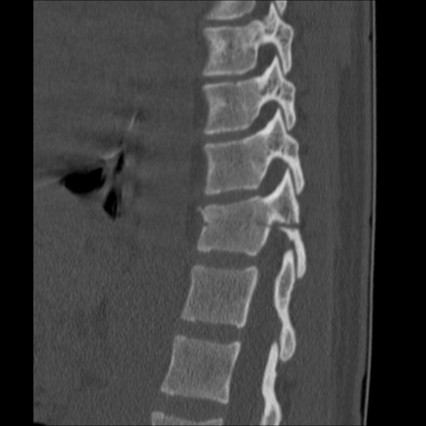 Chance fracture (Radiopaedia 36521-38081 Sagittal bone window 45).jpg