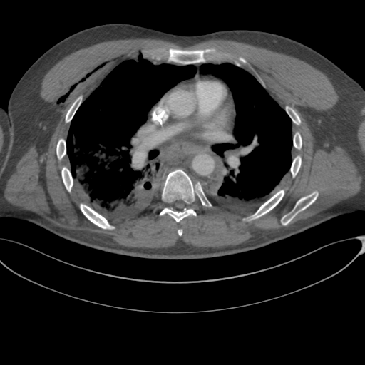 File:Chest multitrauma - aortic injury (Radiopaedia 34708-36147 A 144).png