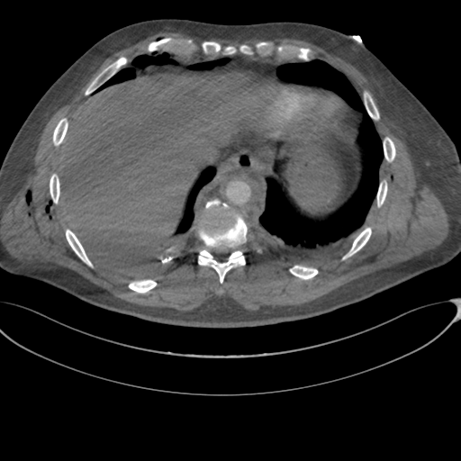 File:Chest multitrauma - aortic injury (Radiopaedia 34708-36147 A 239).png