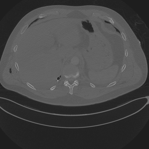 Chest multitrauma - aortic injury (Radiopaedia 34708-36147 Axial bone window 272).png