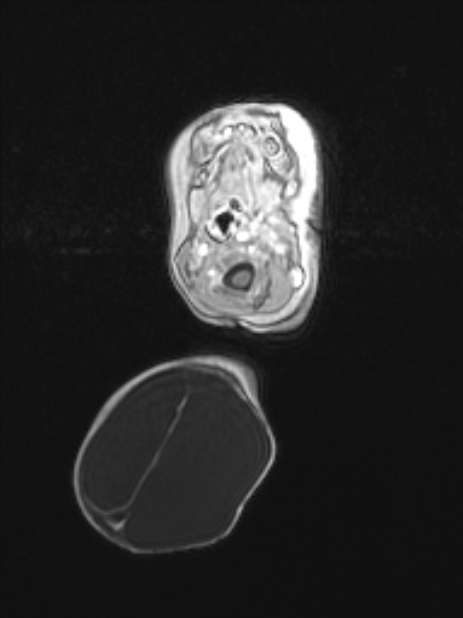 Chiari III malformation with occipital encephalocele (Radiopaedia 79446-92559 Axial T1 C+ mpr 21).jpg