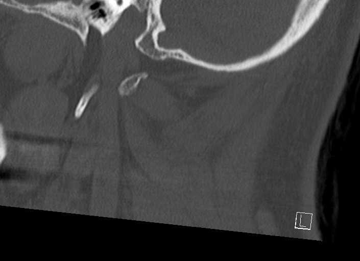 Chiari I malformation with a symptomatic syrinx of the posterolateral medulla oblongata (Radiopaedia 42573-45707 A 49).jpg