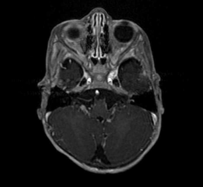 Chiasmatic-hypothalamic glioma (Radiopaedia 90079-107252 Axial T1 C+ 16).jpg