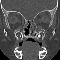 Choanal atresia (Radiopaedia 88525-105975 Coronal bone window 46).jpg