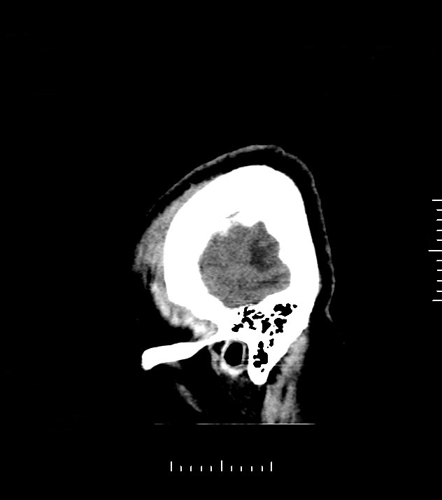 Cholangiocarcinoma with cerebral metastases (Radiopaedia 83519-98628 C 2).jpg